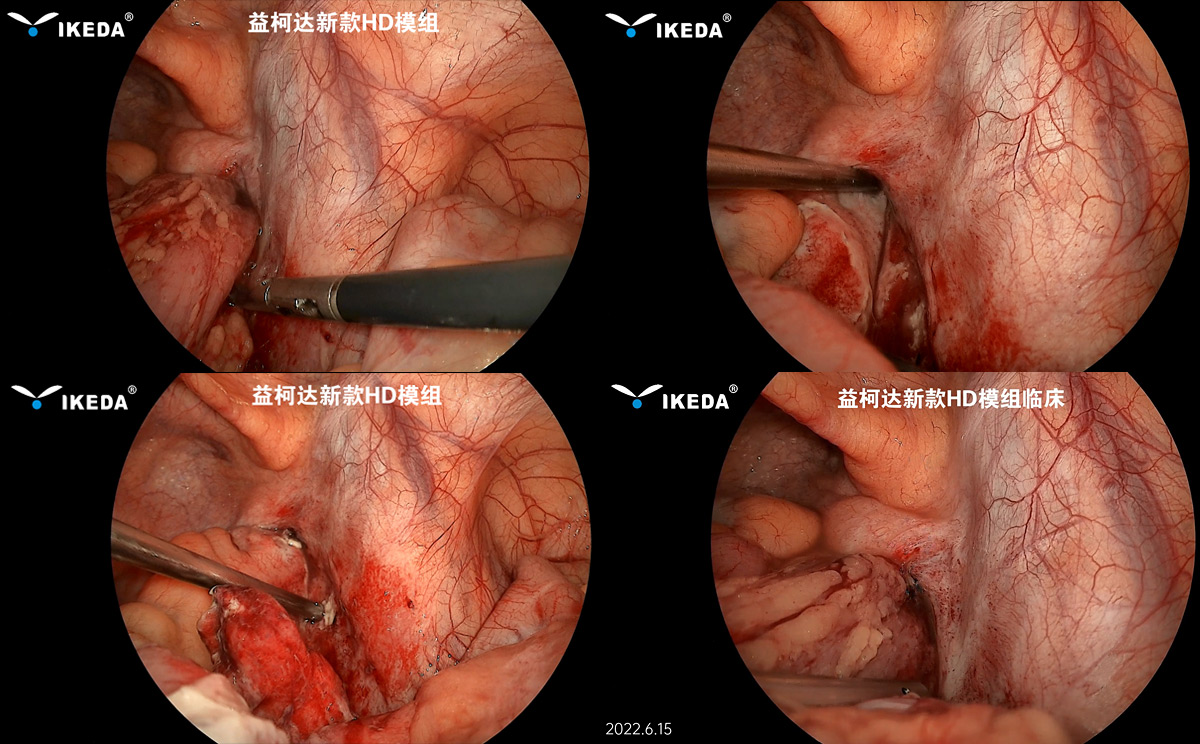 益柯達(dá)-新款HD內(nèi)窺鏡模組首次臨床